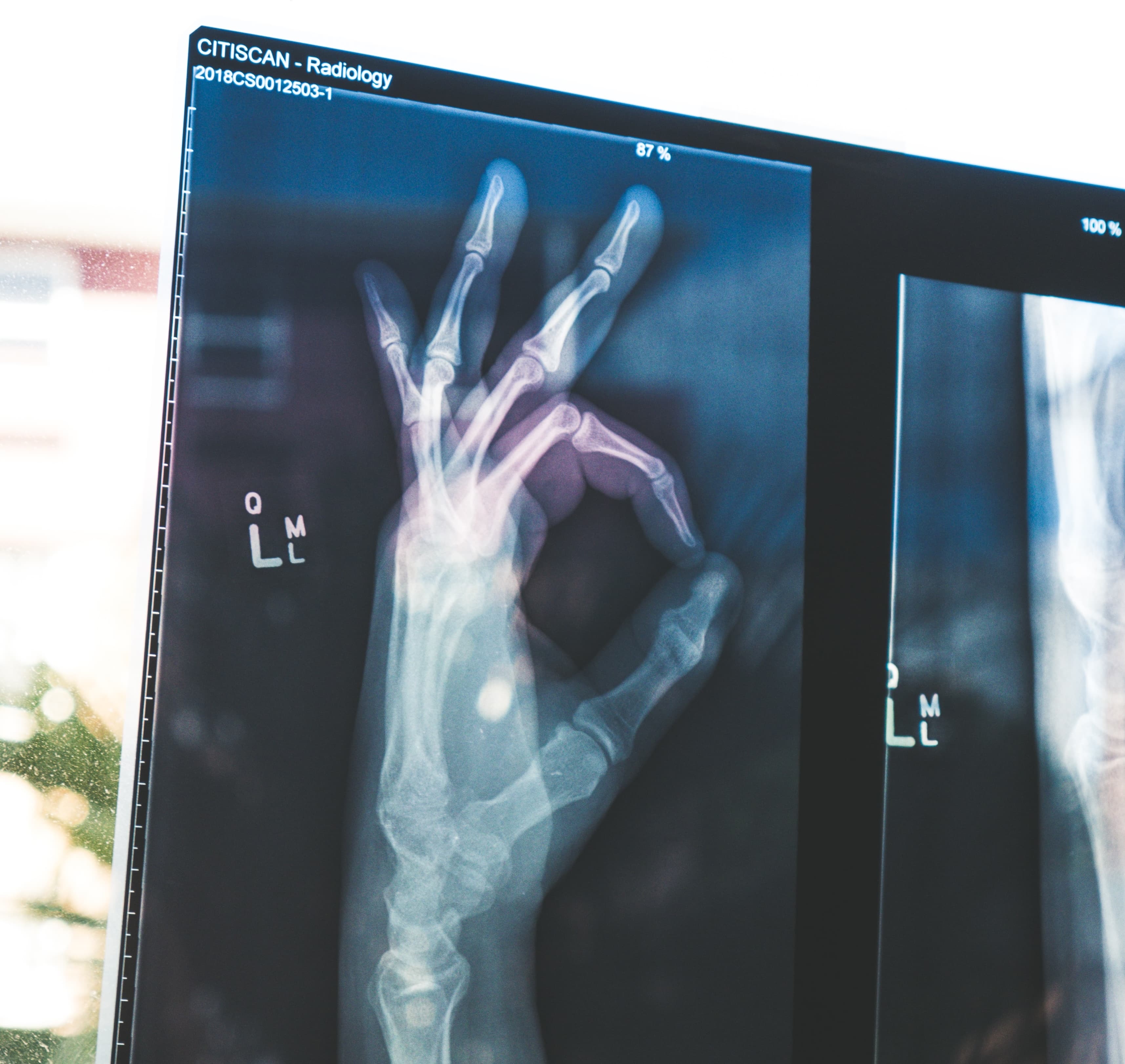 X-Ray of hand making okay sign